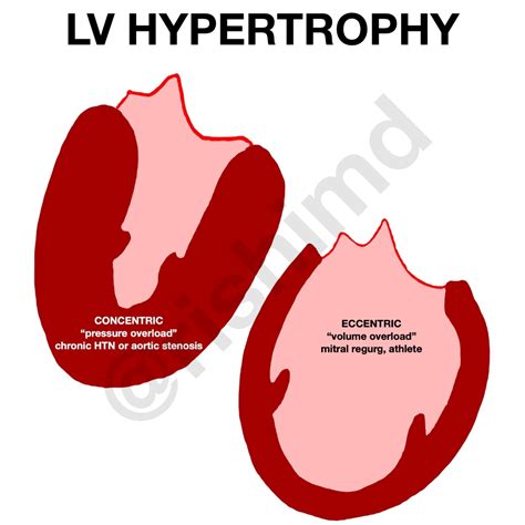 mild lv concentric hypertrophy|concentric vs eccentric hypertrophy causes.